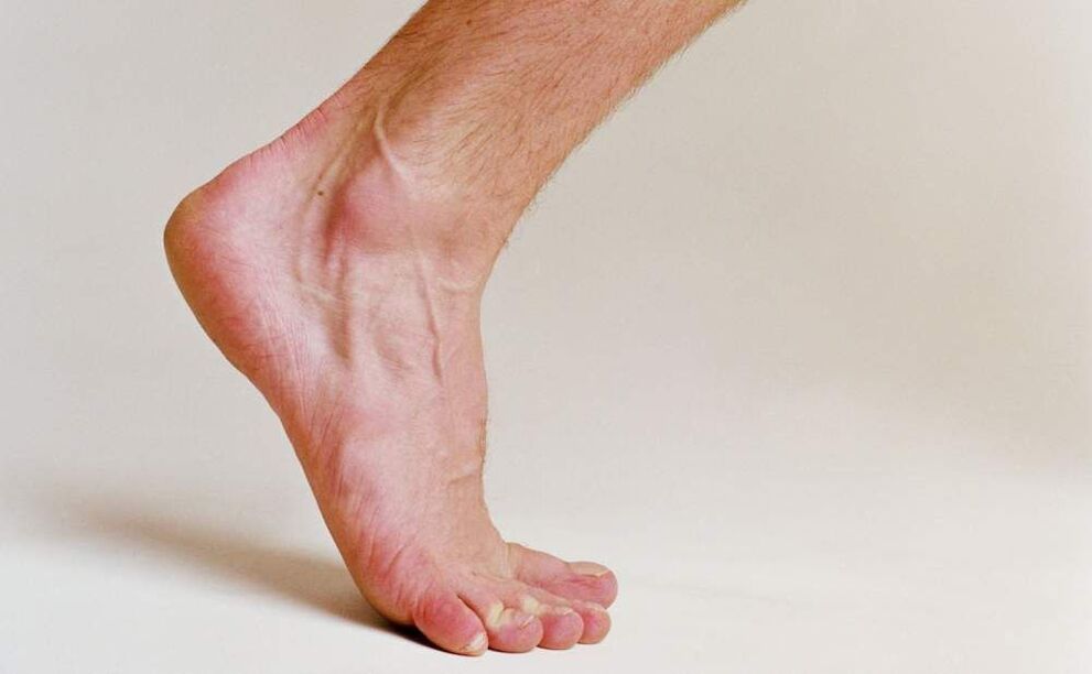 sintomi del piede d'atleta