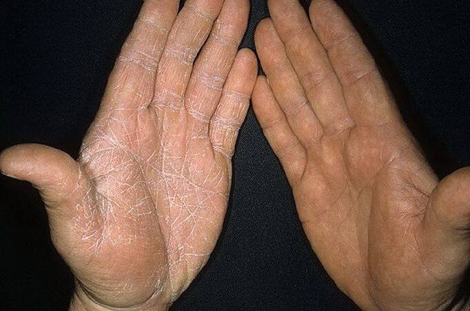 I sintomi di un fungo sulla pelle delle mani