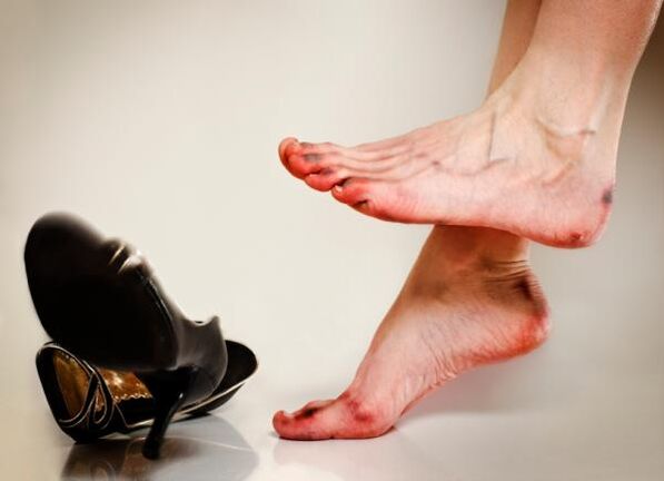 Lo sviluppo dei funghi alle unghie dei piedi può essere causato da scarpe troppo strette