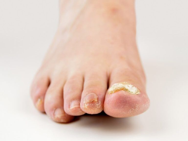 Unghie dei piedi colpite da funghi