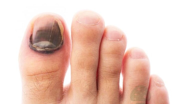 stadio avanzato della malattia con un grande fungo dell'unghia del piede