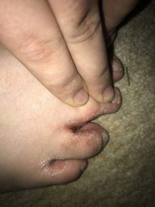 Infezione da fungo del piede